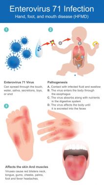 Enterovirus 71 enfeksiyon