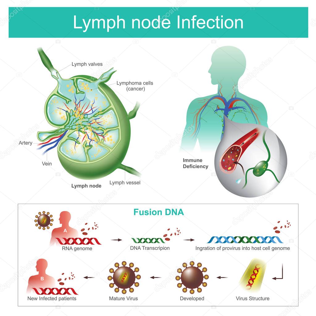 The Lymph nodes are infected Failure of the immune system, the b
