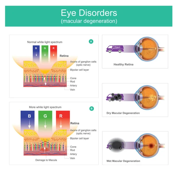 La degeneración macular es una afección médica que puede resultar en visión borrosa o sin visión. Con el tiempo, sin embargo, algunas personas experimentan un empeoramiento gradual de la visión que puede afectar uno o ambos ojos. Ilustración . — Archivo Imágenes Vectoriales