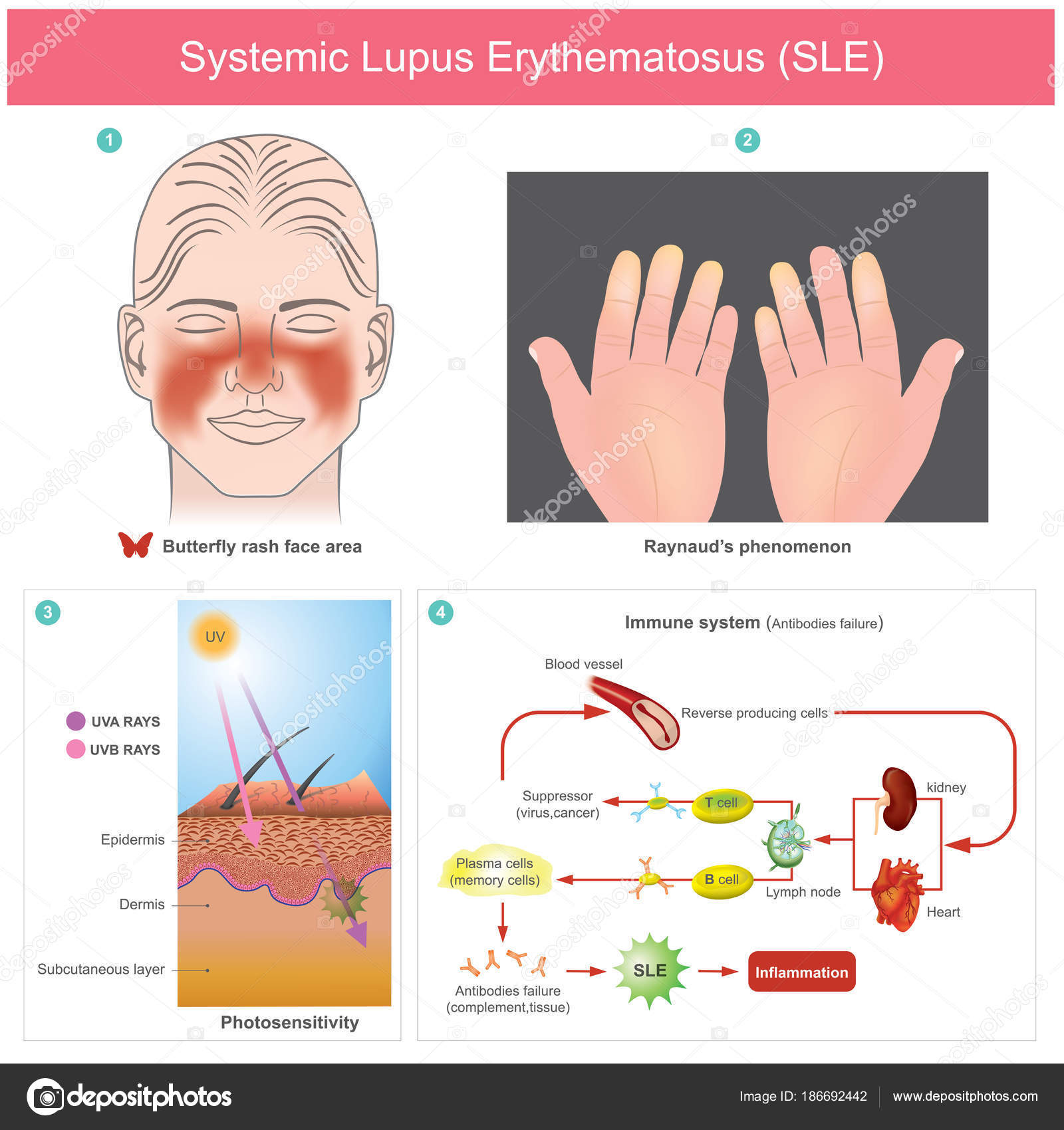 lupus erythematosus bilder lupus erythematosus bilder