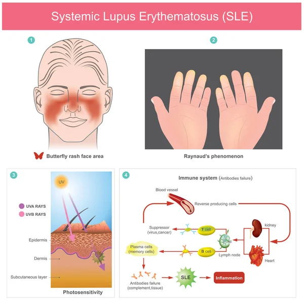 Systemische Lupus Erythematosus (Sle). — Stockvector