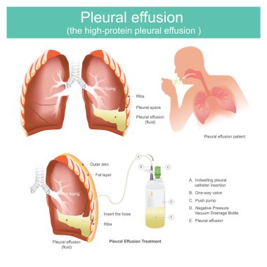 Plevral efüzyon yüksek proteinli plevral efüzyon.