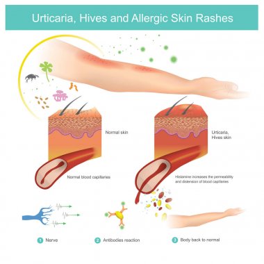 Urticaria, Hives and Allergic Skin Rashes. Illustration. clipart