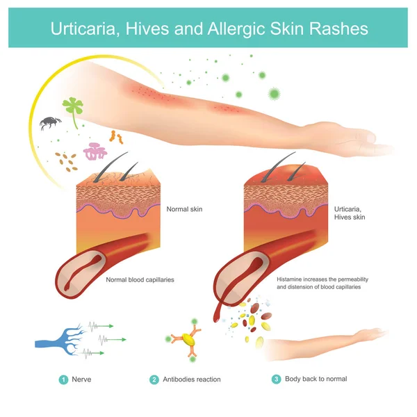 Urticaria, urticaria y erupciones cutáneas alérgicas. Ilustración . — Archivo Imágenes Vectoriales