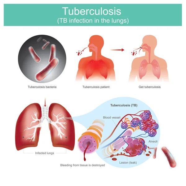 Tuberculosis TB infection in the lungs. — Stock Vector