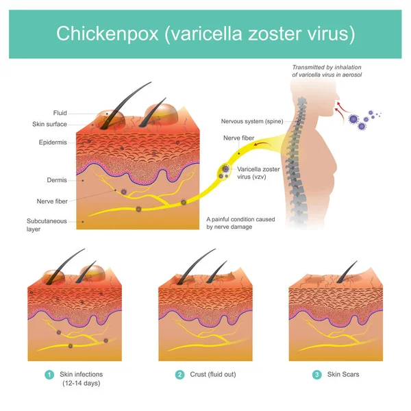 Plané neštovice Plané neštovice zoster virus. — Stockový vektor