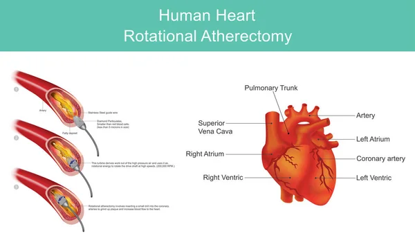Heart Diamond Angioplasty. Illustration. — Stock Vector