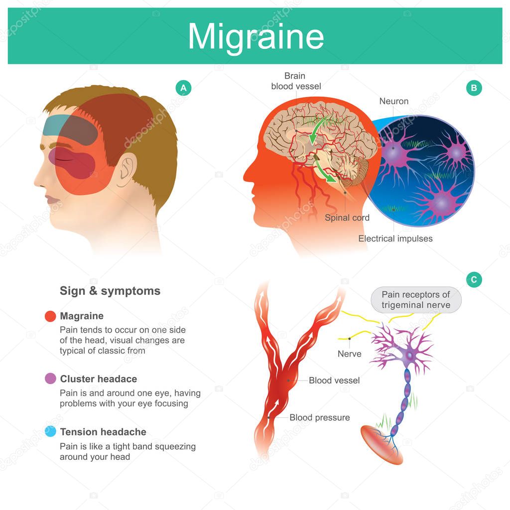 Migraine. Headache pain.