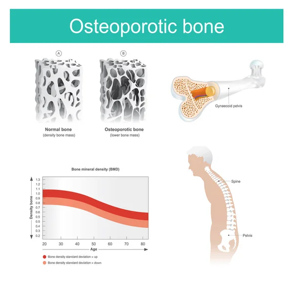 Osteoporotiska ben. Den gamle mannens hälsa försämrats eftersom från avsaknaden av kalcium. — Stock vektor