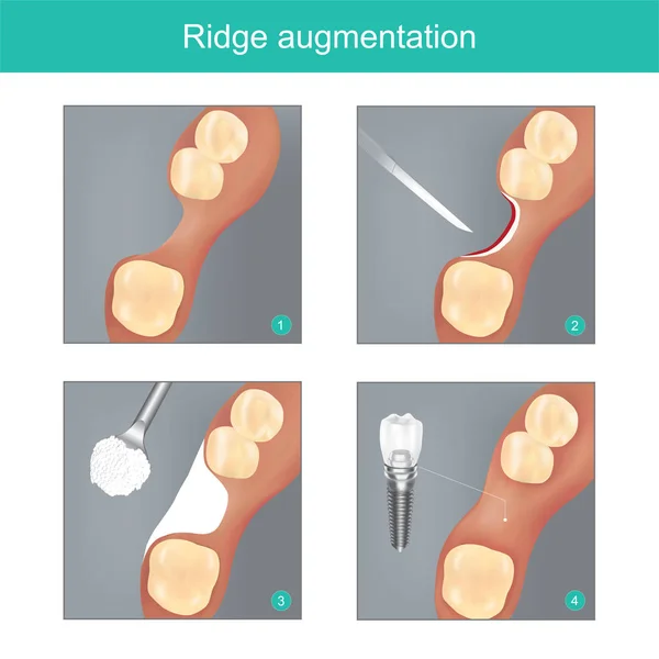 Aumento de cresta. El método dental utilizado materiales sintéticos o — Vector de stock