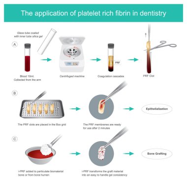 Fibrin zengini trombositler (Prf) dişçilik dalında. Biyolojinin gelişimi