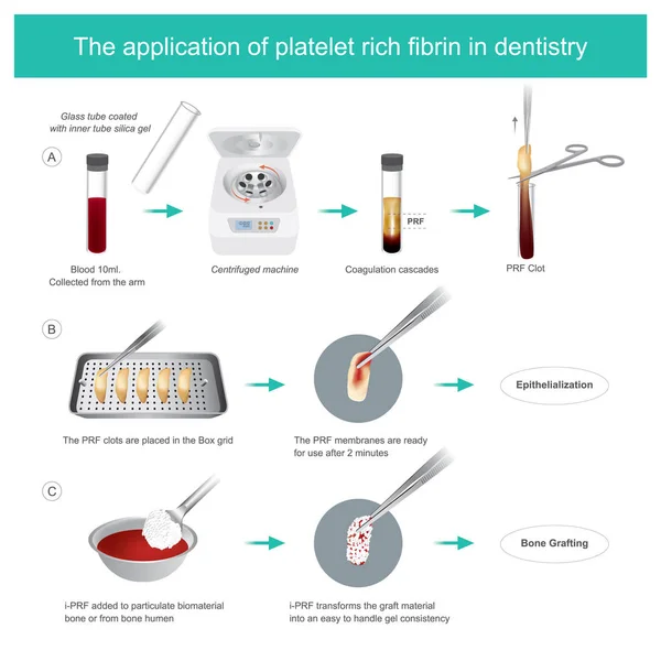 Plaquetas ricas en fibrina (PRF) en odontología. Desarrollo de los biólogos — Archivo Imágenes Vectoriales