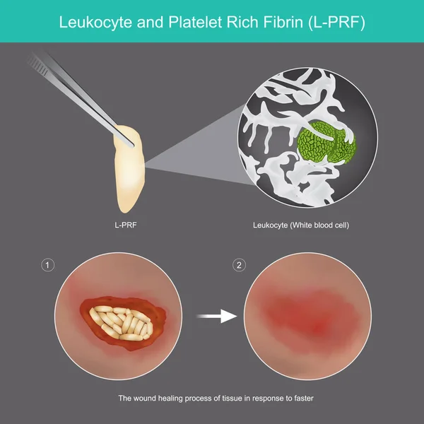 Leucocytes et fibrine riche en plaquettes. Illustration cicatrisation des plaies p — Image vectorielle