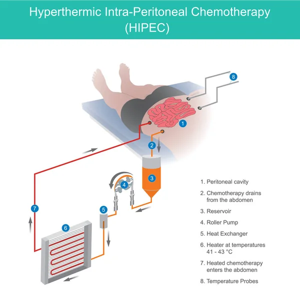 Hipertermik Peritonal Kemoterapi. Kemoterapi kullanımı — Stok Vektör