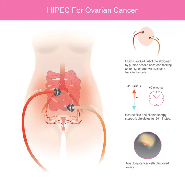 Hipec για καρκίνο των ωοθηκών. Η χρήση της χημειοθεραπείας για την καταστροφή ωαρίων — Διανυσματικό Αρχείο