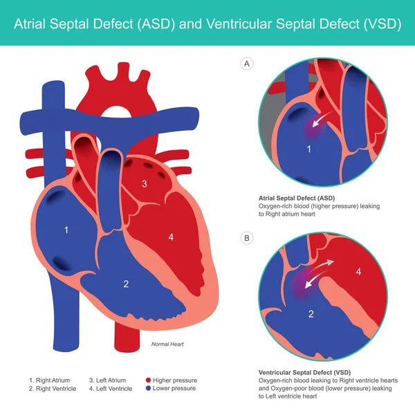 Atrial Septal Defect Asd Ventricular Septal Defect Vsd Abnormal Heart — Stock Vector