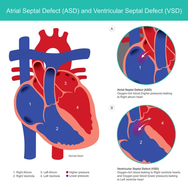 Defecto Septal Auricular Tea Defecto Septal Ventricular Civ Anormal Aurícula — Vector de stock