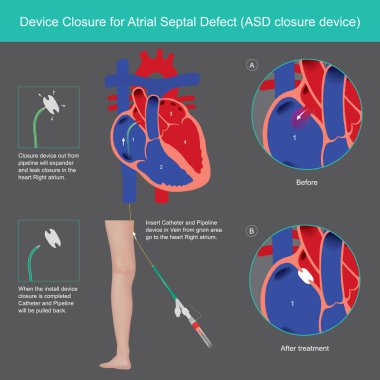 Atrial Septal Bozukluğu için Aygıtlar Kapanışı. Tedaviyi açıkla Atrial Septal Kusur (ASD) anormalliği tıbbi cihazlar kullanarak Sağ atriyumdaki duvarın kalbini kapatarak.