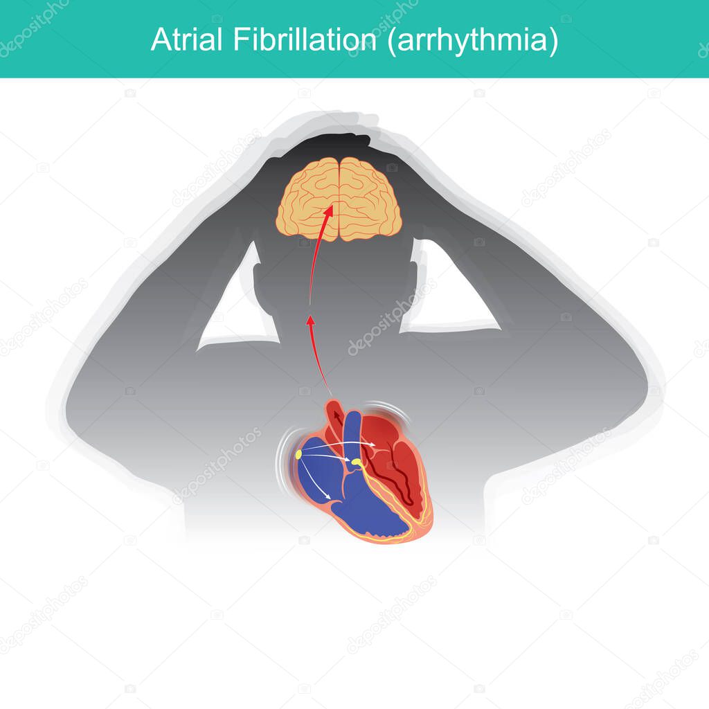 Atrial Fibrillation. Patients condition in which the electrical signals in heart malfunctioning or causing a short circuit in heart rhythm.
