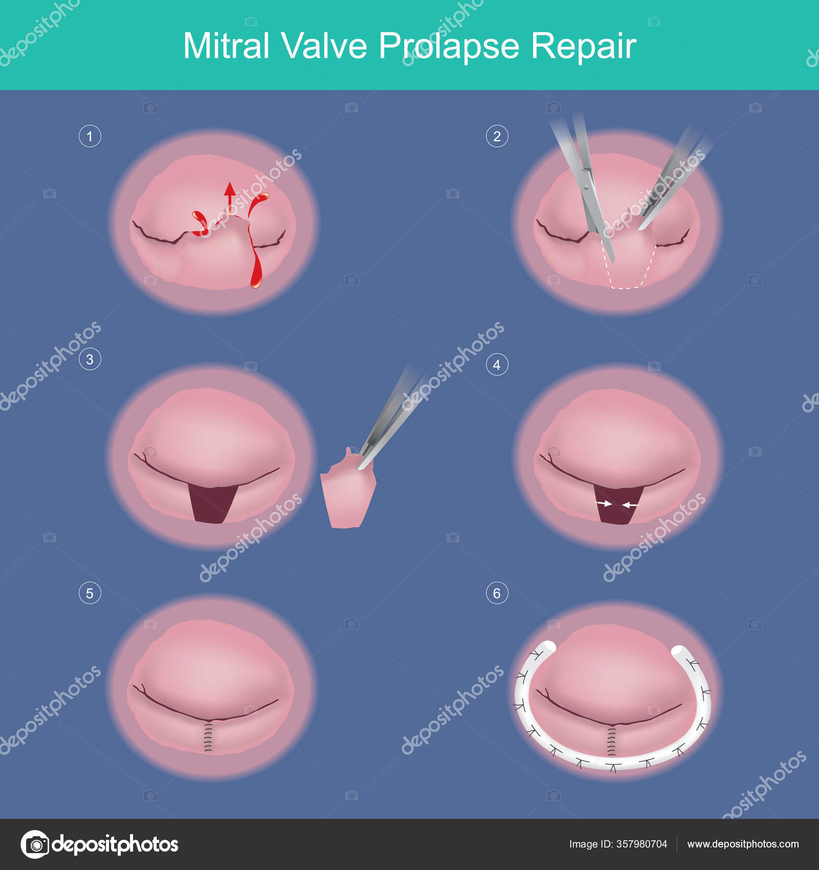 Minimally Invasive Surgical Mitral Valve Repair: State of the Art Review |  ICR Journal