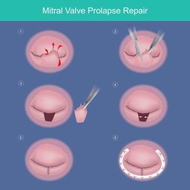 Mitral Valve Prolapse Repair. The method repair heart valve by surgery removed damaged or abnormal leaked segment and used Synthetic material ring (medical parts) for tissue strength. clipart