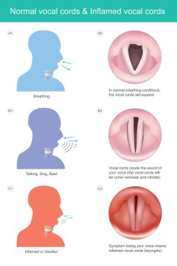 Normal vocal cords & Inflamed vocal cords. The vocal cords create the sound of your voice for speaking or sing, if losing your voice means vocal cords inflamed symptom clipart