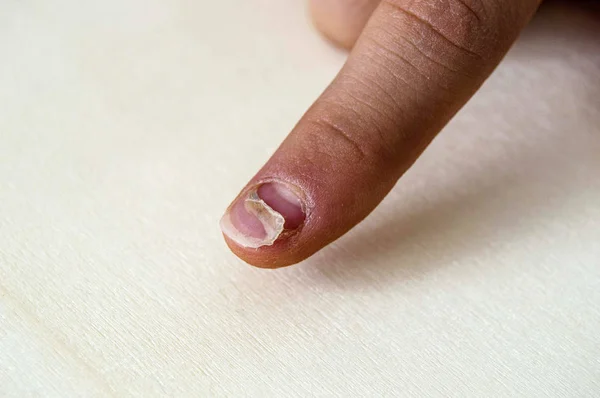 Das Nagelwachstum Bei Kindern Nageltropfen Bei Babys Wiederauftauchen Von Handnägeln — Stockfoto