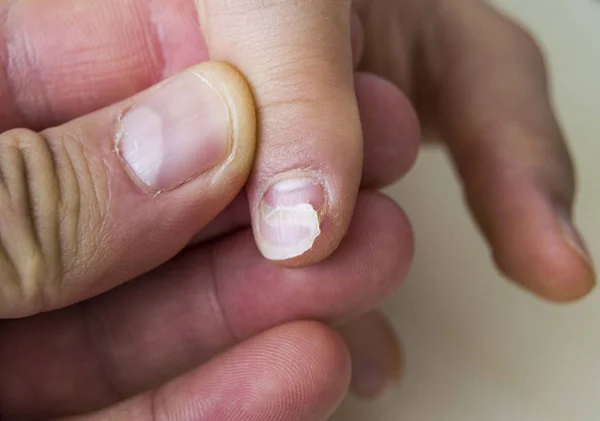 Das Nagelwachstum Bei Kindern Nageltropfen Bei Babys Wiederauftauchen Von Handnägeln — Stockfoto