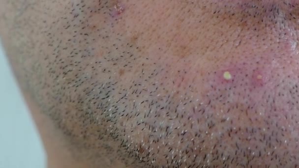 Eine Entzündete Akne Auf Einem Männlichen Gesicht Eine Entzündete Akne — Stockvideo