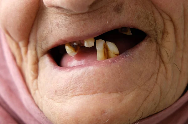 Dişleri olmayan yaşlı bir kadın, ağzında birkaç dişi olan yaşlı bir kadın.,