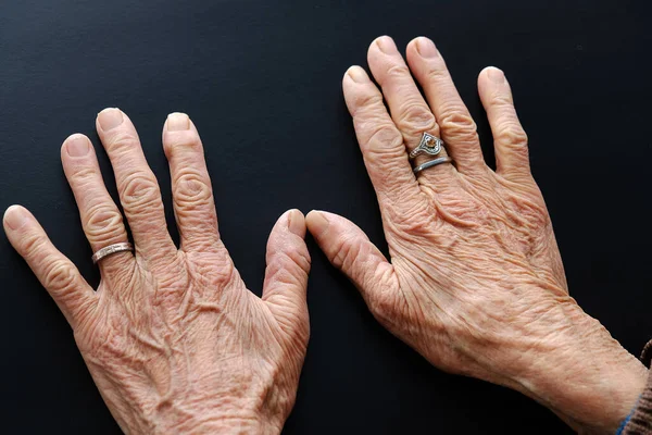 Dłoń Starszej Kobiety Pierścionkiem Palcu Dłoń Palce Starszej Kobiety — Zdjęcie stockowe