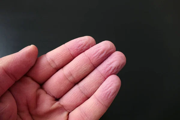 Suda kalan parmak kırışıklıkları, su yüzünden buruşmuş parmak uçları.,