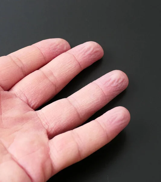Falten Der Finger Die Wasser Zurückgelassen Werden Zerknitterte Fingerkuppen Aufgrund — Stockfoto