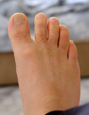 Ayak parmaklarında mantar hastalığı, ayak parmaklarında mantar oluşumu, insan ayağı ve mantar.,