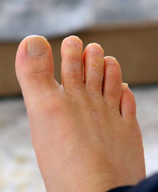 Ayak parmaklarında mantar hastalığı, ayak parmaklarında mantar oluşumu, insan ayağı ve mantar.,