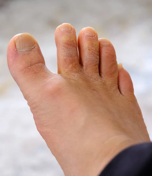 Грибковые Заболевания Пальцах Ног Образование Грибов Пальцах Ног Ступней Человека — стоковое фото