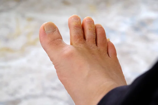 Грибкові Захворювання Пальцях Ніг Формування Грибка Пальцях Ніг Нозі Людини — стокове фото