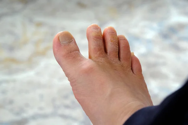 fungal disease on the toes, fungus formation on the toes, human foot and fungus,