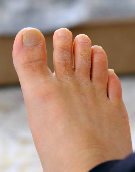 fungal disease on the toes, fungus formation on the toes, human foot and fungus,