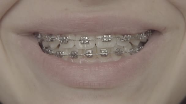 Τα γυρίσματα του δόντια με σιδεράκια. Χαμόγελο — Αρχείο Βίντεο