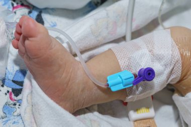 Yeni doğan bebek ayak ven Periferik damar içi kateter