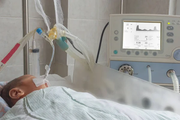 Newborn baby on breathing machine in neonatal intensive care unit