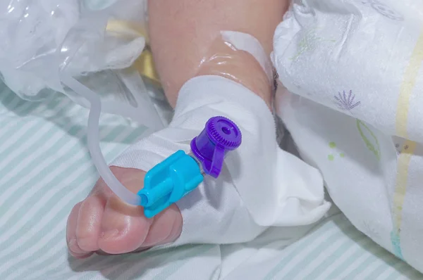 Catetere endovenoso periferico nella vena del piede del neonato — Foto Stock