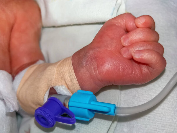 Периферический внутривенный катетер в вене новорожденной руки ребенка
