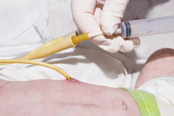 L'infermiera sta alimentando attraverso il tubo g dopo la gastrostomia del neonato in unità di terapia intensiva neonatale presso l'ospedale per bambini — Foto Stock