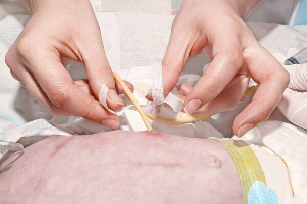 Медсестра чинит желудочно-кишечную трубку медицинским пластырем новорожденного в отделении реанимации новорожденных в детской больнице

