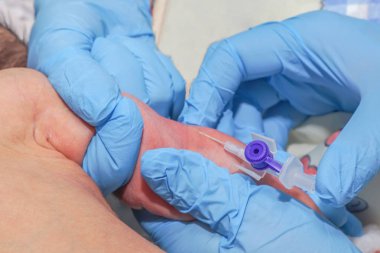 Yeni doğan bebeğin Yenidoğan yoğun bakım ünitesinde intravenöz Kateterizasyon