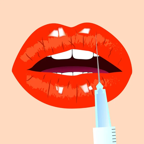 Dudaklar ve botox enjeksiyon. Kırmızı dudaklar. Güzellik kavramı, vektör çizim