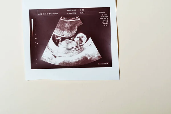 Ultrasound scan of a child.  20 weeks, 5 months — Stock Photo, Image