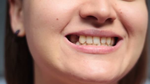 Девушка показывает зубы и отверстие после удаления зубов — стоковое видео